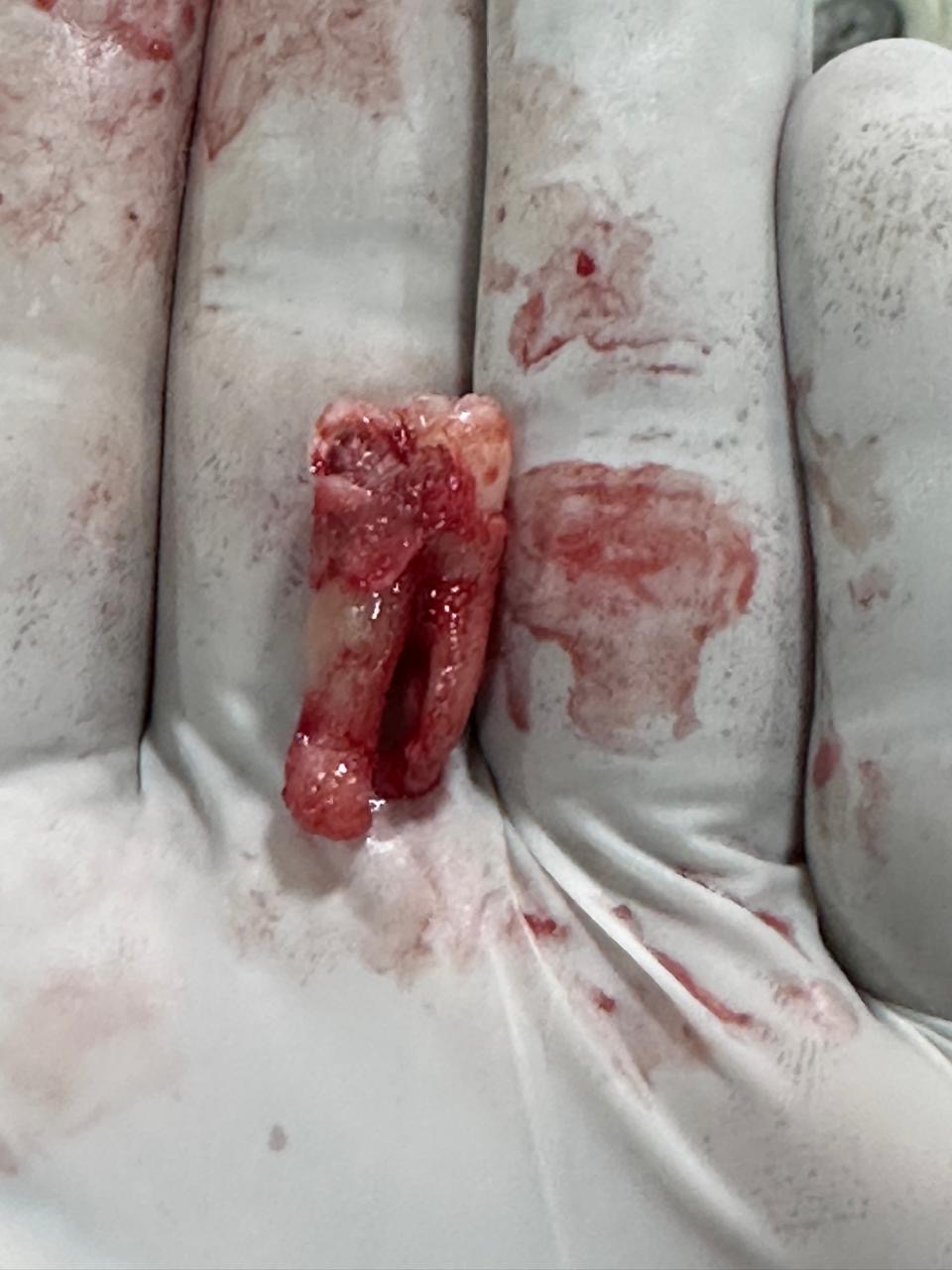 Surgically extracted multi-root molar dental case detail